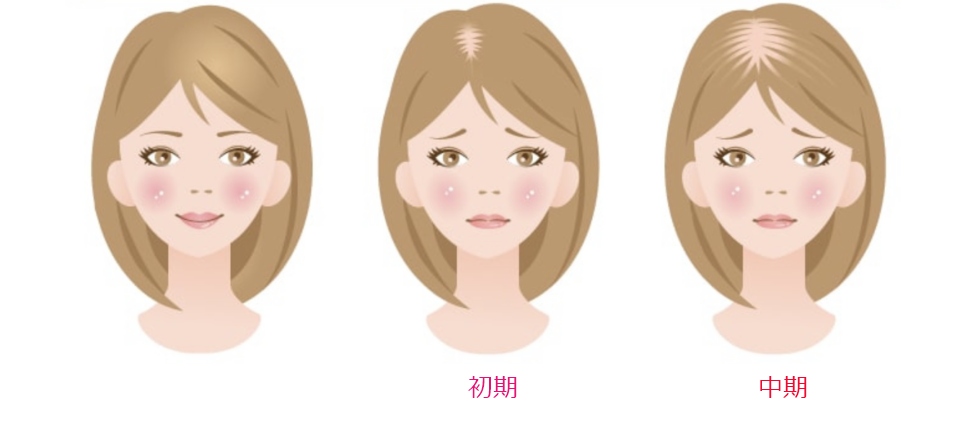 女性のびまん性薄毛症は進行していきます